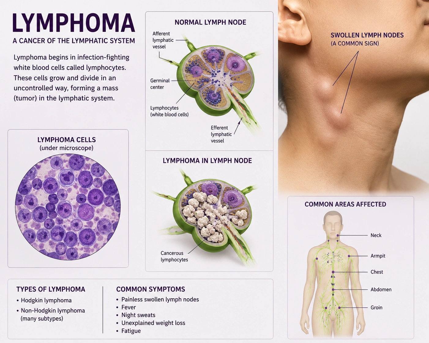 Lymphoma Cancer Treatment